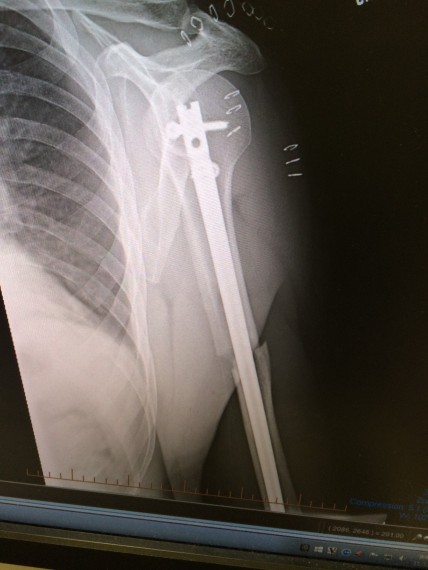 X-ray after rod surgery